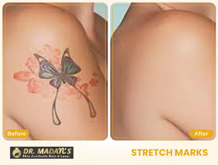 Stretch marks before and after result 2 at Dr Madan Aesthetics